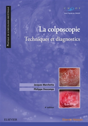 La colposcopie : technique et diagnostics - Jacques Marchetta
