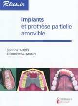 Implants et prothèse partielle amovible - Corinne Taddéi